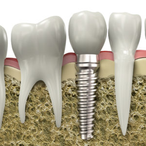 dental-implants-san-diego