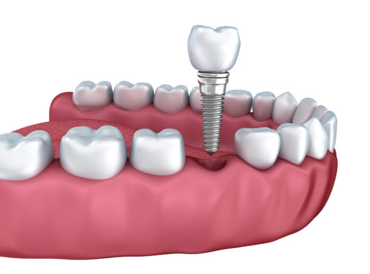 teeth and dental implant 
