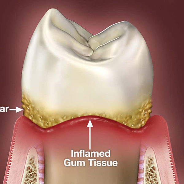 gum-disease san diego