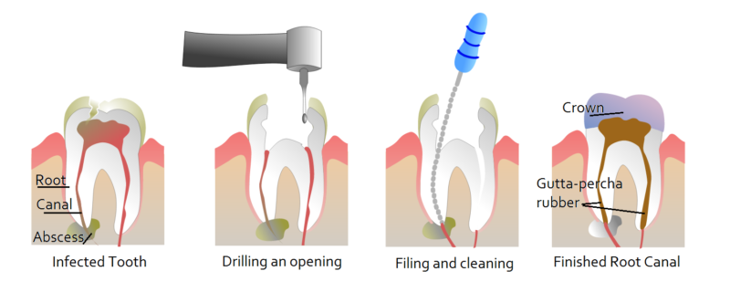 root-canal-treatment-san-diego