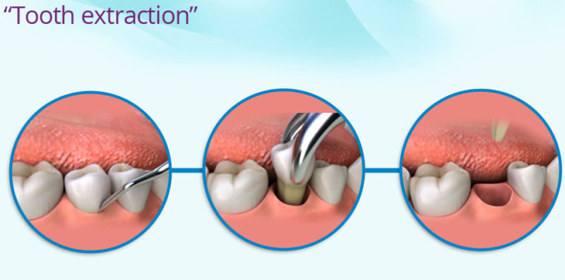 tooth_extraction-in-san-diego