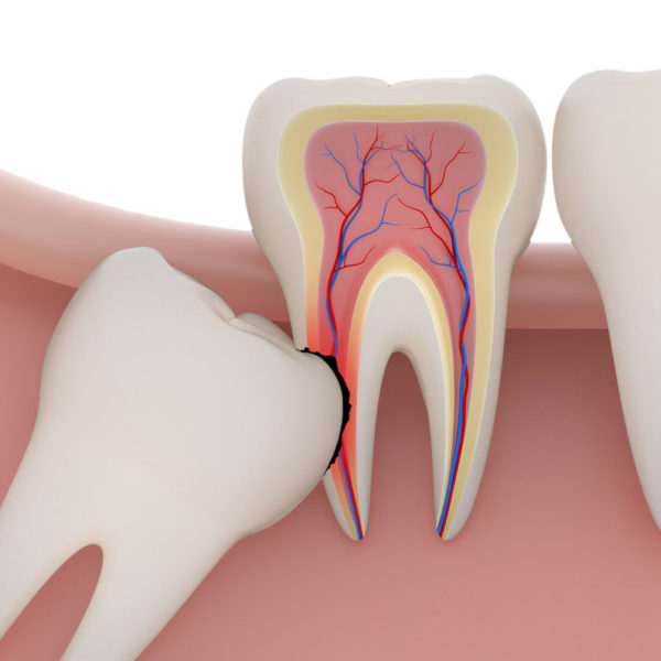 wisdom-tooth-extraction san diego